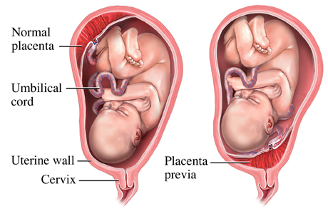 Normal placenta versus placenta previa chart