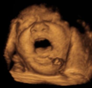 Yawning before birth!
