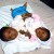 Morocian conjoined or Siamese twins Morocian conjoined or Siamese twins