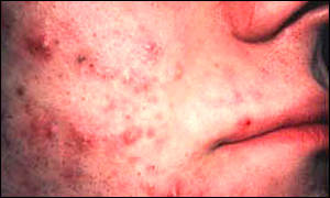 In this photo, courtesy of Google Images: the link between bread and acne.