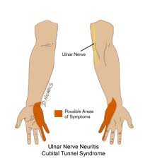 Your brief guide to cubital tunnel syndrome