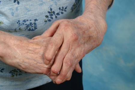 Rheumatoid Arthritis arxmanhealth.com