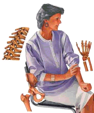 osteoporosis - a dillemma for older women