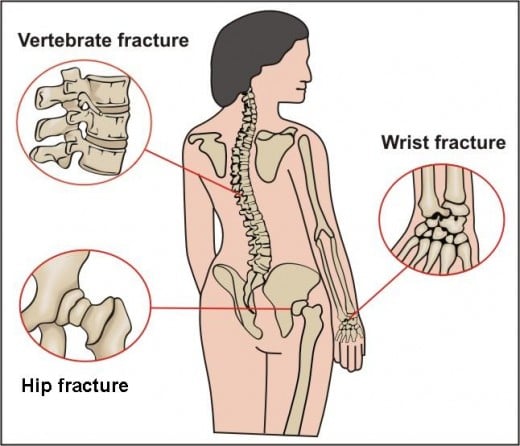 osteoporosis common fracture sites