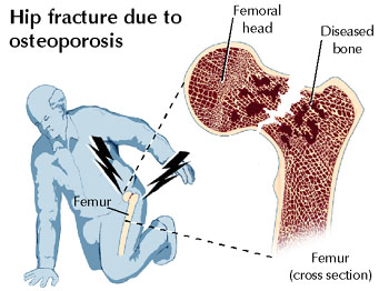 Hip fractures caused by osteoporosis
