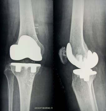 Picture of knees with replacement joints. 