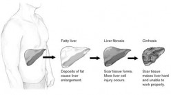 Non Alcoholic Fatty Liver Disease (NAFLD) and Non Alcoholic Steatohepatitis (NASH)
