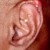 Gout. Tophaceous deposits in ear. Gout. Tophaceous deposits in ear.