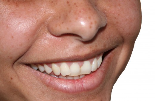 Want to know how to whiten teeth?  You can go the home technique or the natural technique.