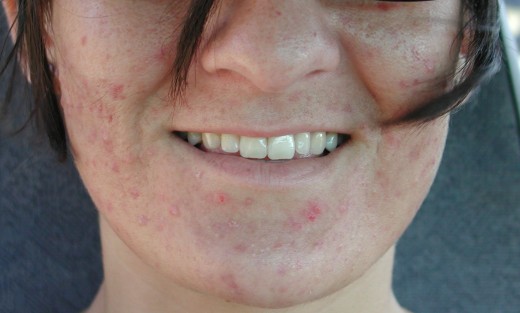My acne on a "good day" before I found my cure.