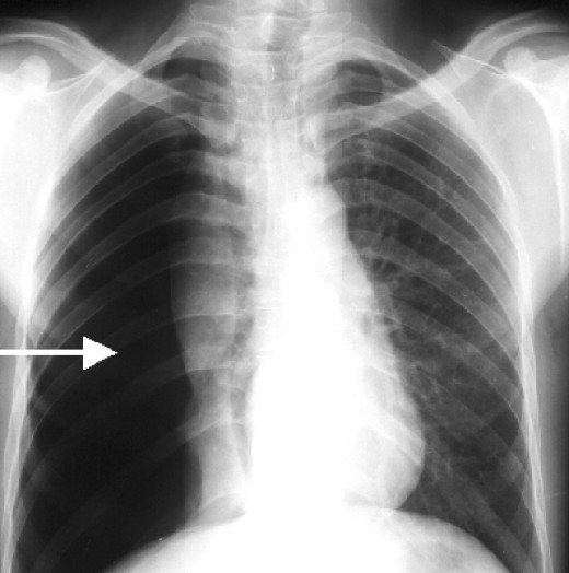 Collapsed Lung Dealing With A Collapsed Lung - Pneumothorax