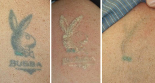 Laser Tattoo Removal