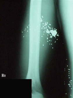 X-ray of Glaser Wound