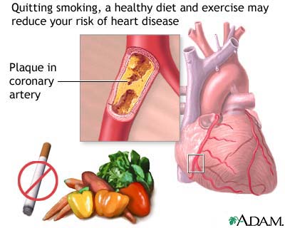 Heart disease lifestyle changes