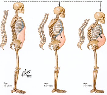 Progression of breakage of vertebrae 
