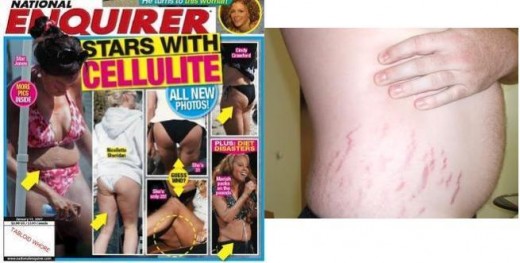 cellulites and stretch marks yikes!