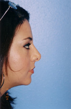 After Rhinoplasty