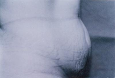 Before Full Tummy Tuck
