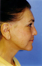 After lower facelift