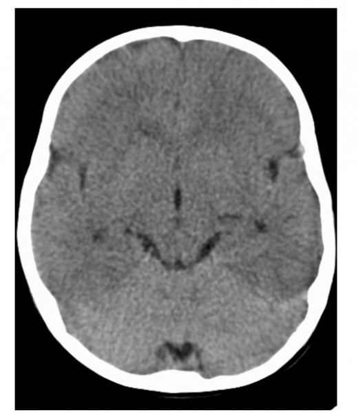 MRI view of cerebral edema