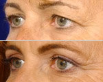 Blepharoplasty smoothes over the wrinkles, and apparently somehow gives you a better tan.