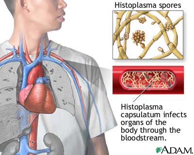 Histoplasmosis is a fungal infection caused by inhaling dust from spore-infected bird droppings. In the disseminated form, infection spreads throughout the body from the lungs. The death rate is fairly high for people with untreated widespread (disse