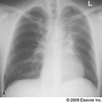 Posteroanterior chest radiograph shows poorly defined increased opacity of the left hemithorax associated with superior displacement of the left hilum and elevation of the left hemidiaphragm characteristic of left upper lobe atelectasis. The patient 