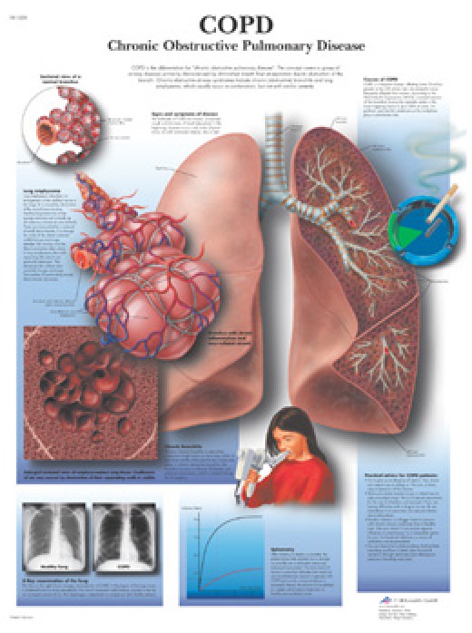 Ailments causing Bronchial obstruction- Especially, Chronic Obstructive ...