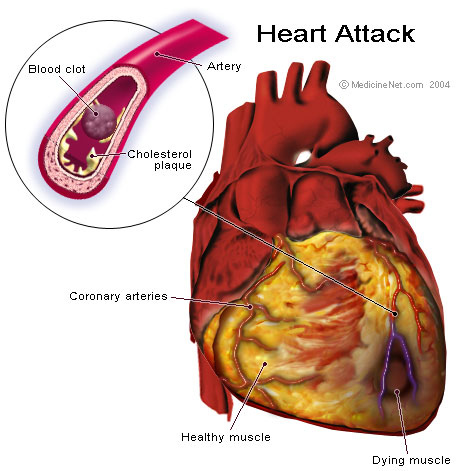 Heart attack, being caused due to blockage in arteries.
