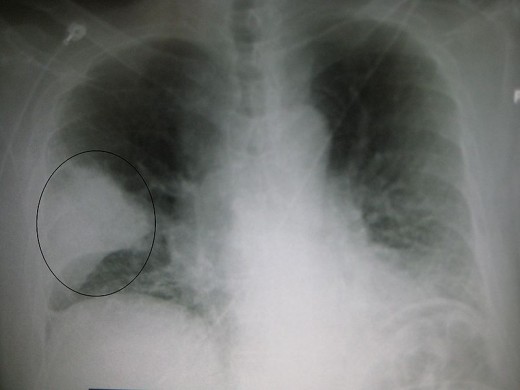 Xray  of a pneumonia patient.