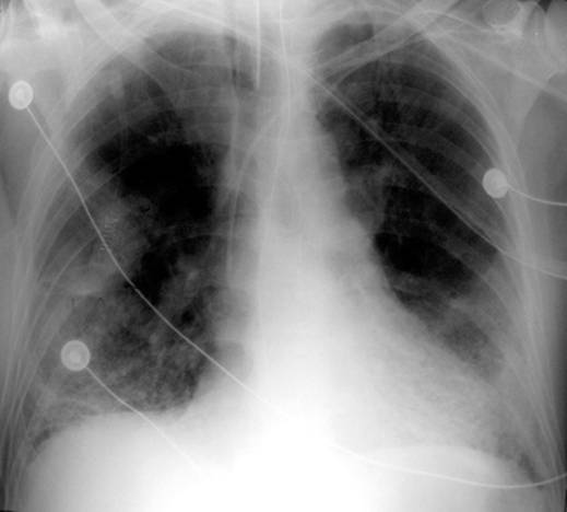 X-ray of patient with chronic bronchitis (COPD) and respiratory failure. The signs are characteristic to main disease.