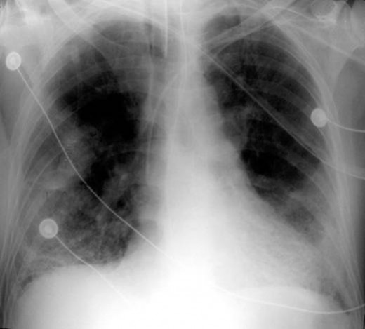 PULMONARY INSUFFICIENCY, (RESPIRATORY FAILURE) | HubPages