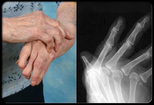Joint X-rays can also be helpful in monitoring the progression of rheumatoid disease and joint damage over time.
