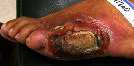 diabetic foot ulcer