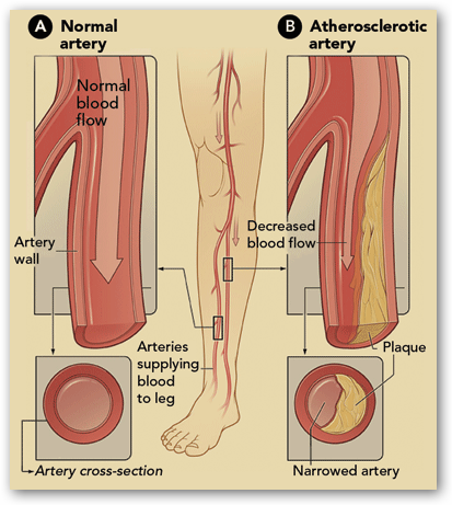 narrowing of the femoral artery