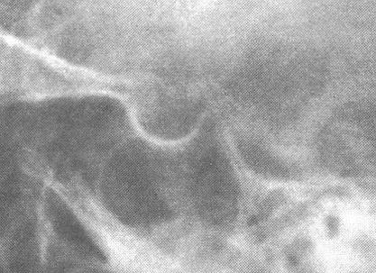 Cerebral angiography is useful in establishing the presence of parasellar lesions, determining the degree of suprasellar or parasellar extension of a pituitary tumor, excluding the presence of an aneurysm, and determining whether major vessels are in