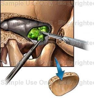 Craniotomy is reserved for large tumors with suprasellar extension and involvement of the optic chiasm. Cryohypophysectomy (destruction of the pituitary by cold injury) can reduce the secretion of growth hormone without causing hypopituitarism in 88 