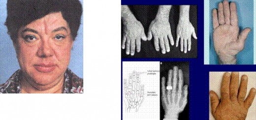 Bone overgrowth and soft tissue thickening lead to characteristic coarsening of the facial features. The hands are widened and the fingers become broad, requiring a larger  ring size. Similar changes in the feet require a larger shoe size. This incr