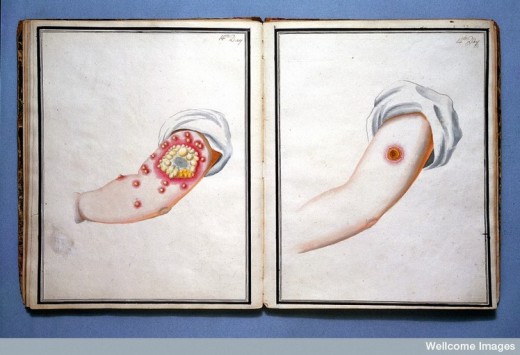 small pox spots