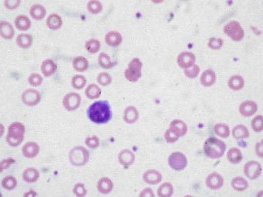 Blood sample film of a person with Iron Deficiency Anemia