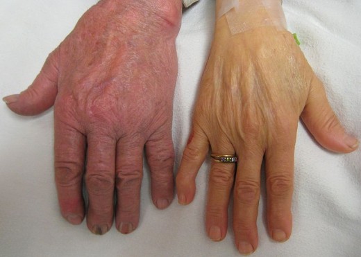 A person's hand having severe anemia (right) compared to a normal hand.