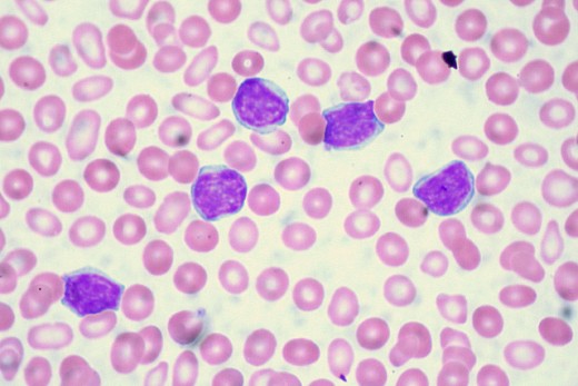 Blood film of a patient with Chronic Lymphocytic Leukemia
