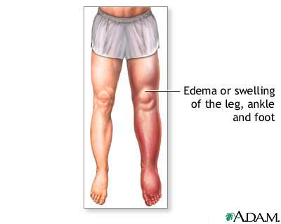 Oedema of the left leg