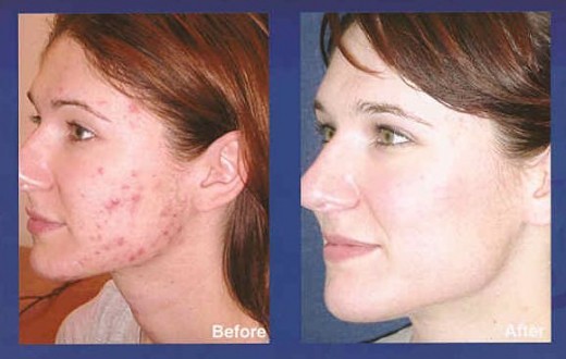 This picture looks photo-shopped, but you get the idea! Clear up that acne with one of the best selling acne products!