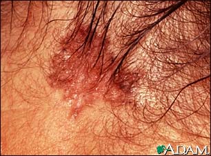 basal cell carcinoma of the scalp