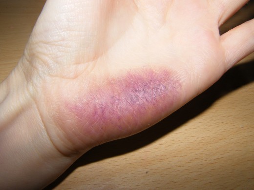 fake-injuries-how-to-make-a-fresh-purple-bruise-and-a-yellow-healing