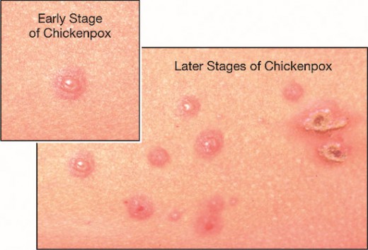 chickenpox blisters