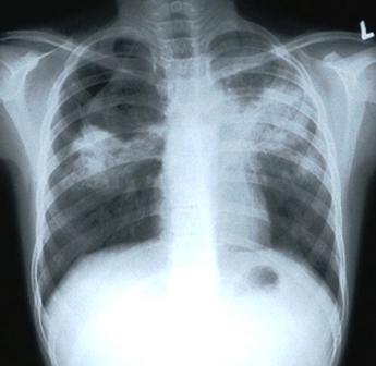 chest X-ray showing shadows caused by TB