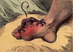 What Causes Gout?