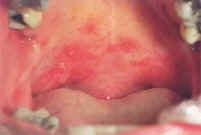 herpetiform ulcer